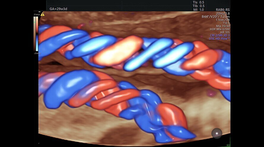 Ecografie a cordului fetal capturată cu Radiantflow
