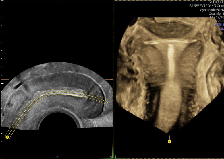 Intrauterin eszköz OmniView segítségével rögzített ultrahangképe