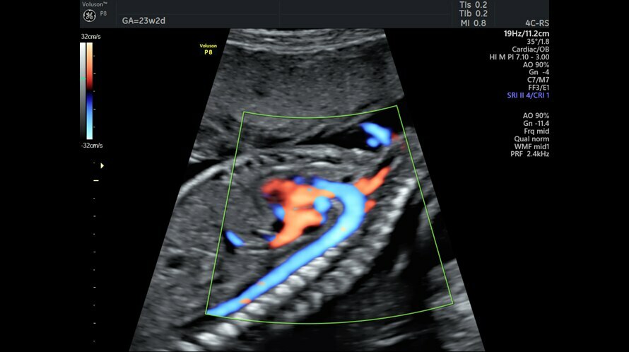 HD-Flow használatával rögzített ultrahangkép az aortaívről