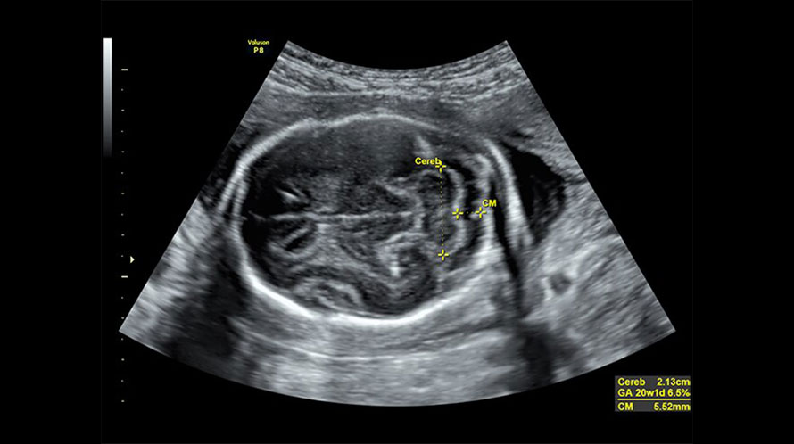 Ultrazvukový snímek cerebella a cisterny magna plodu
