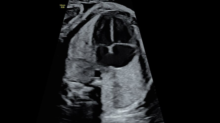 Magzati 4 kamrás szív ultrahangképe