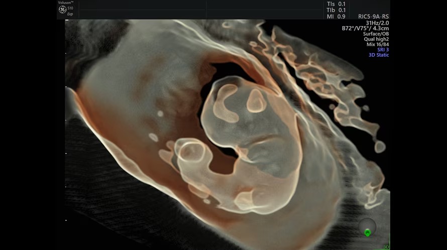 Ecografie ce prezintă un fetus de 8 săptămâni, capturată cu HDlive Silhouette