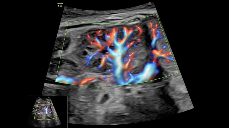 Ecografie ce prezintă un rinichi fetal, capturată cu Radiantflow