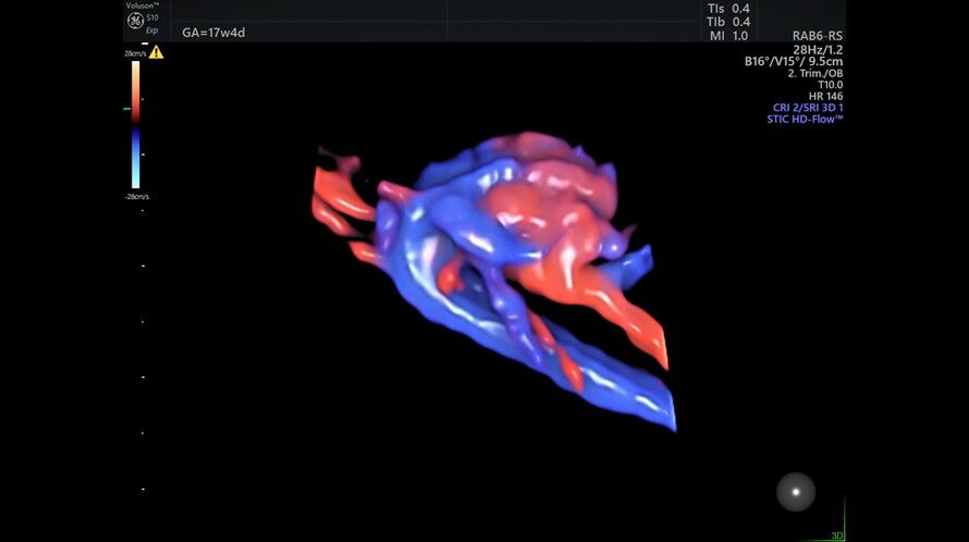 Ultrazvukový snímek zachycený pomocí funkce HD Flow