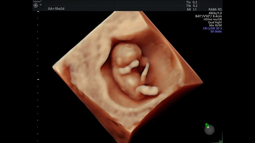 Imagine ecografică a unui fetus de 10 săptămâni