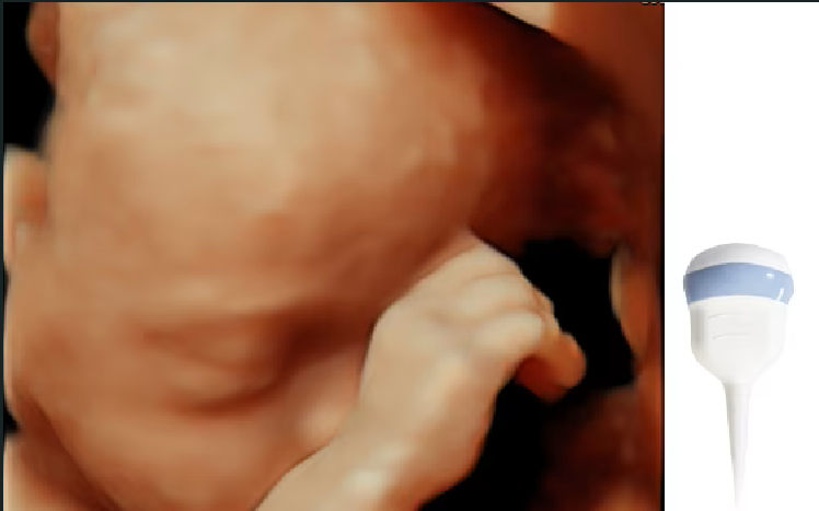 Ultrasound image of a fetus captured with a RAB6-RS probe