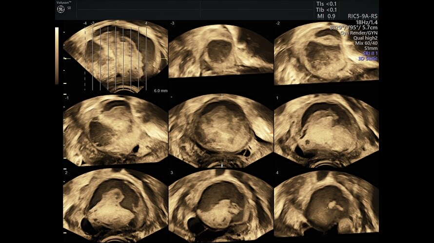Obraz ultrasonograficzny złożonej struktury jajnika