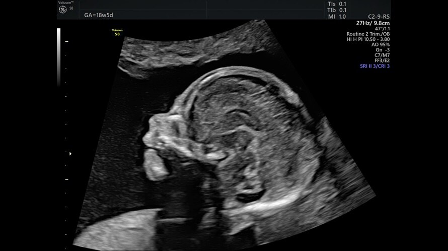 Obraz ultrasonograficzny profilu płodu