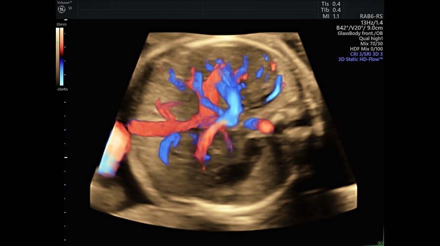 Obraz ultrasonograficzny serca płodu wykonany przy użyciu Radiantflow