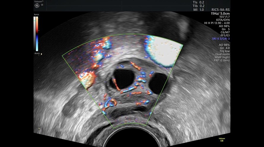Obraz ultrasonograficzny jajników uzyskany przy użyciu HD-Flow
