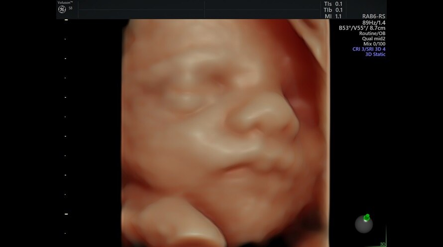 Obraz ultrasonograficzny twarzy płodu zarejestrowany przy użyciu HDlive