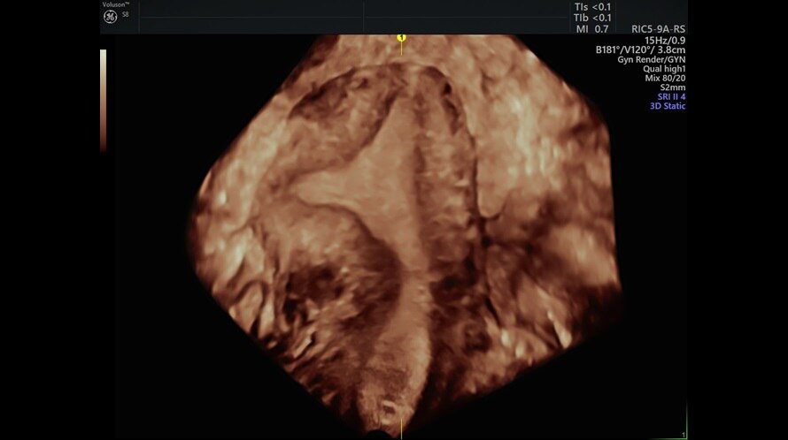 Imagine ecografică a uterului obținută cu OmniView