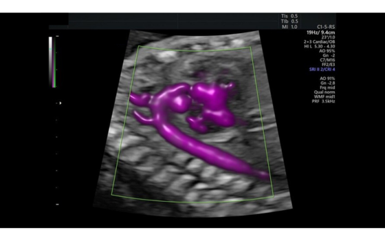 Ultrazvukový snímek aortálního oblouku zachycený pomocí funkce Radiantflow